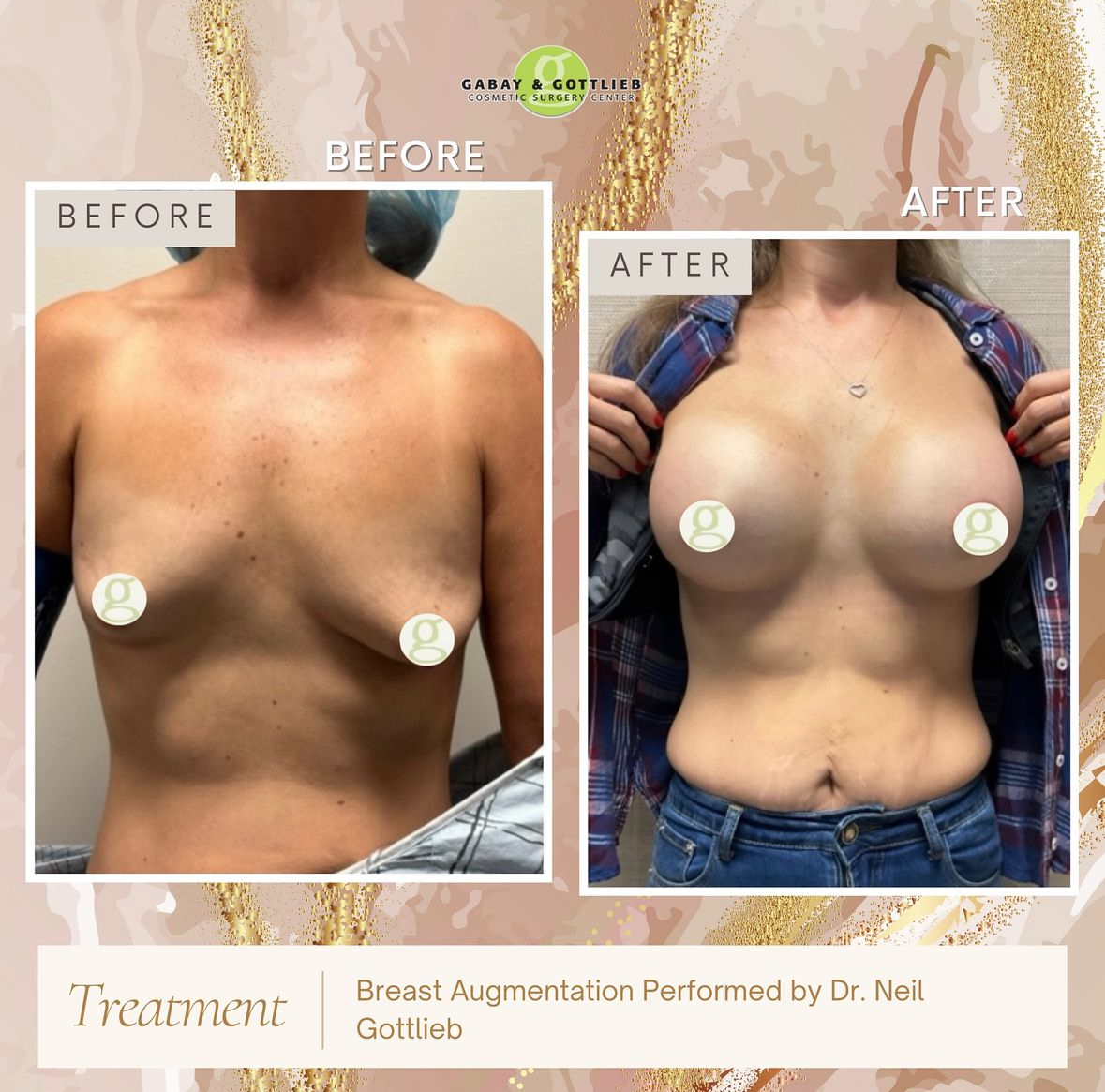 best price breast aug philadelphia