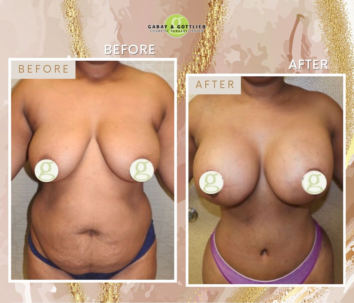amazing breast aug resaults